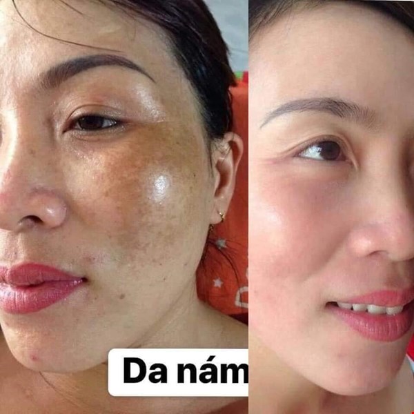 Kem Trị Nám Charme Lumino